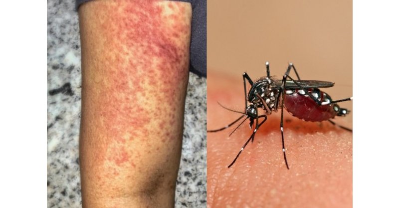 Anvisa libera produção brasileira da 1ª vacina contra chikungunya do mundo; quem não pode tomar