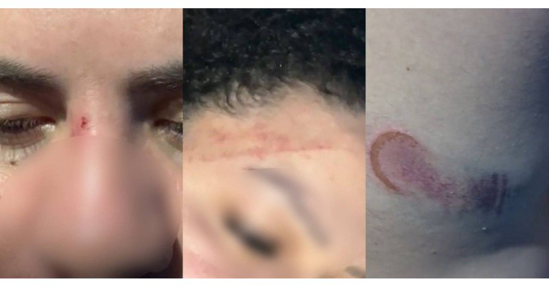 Mulher que levou tapa de PM em Florianópolis mostra hematomas: 'Chegaram jogando spray de pimenta'