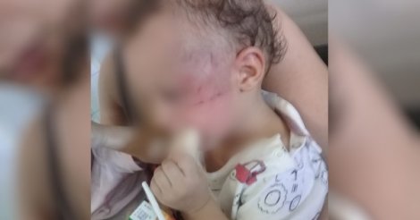 Bebê de 11 meses dá entrada em hospital com lesões graves e fratura no fêmur em SC; padrasto é preso